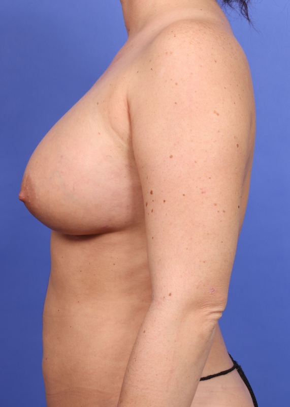 Fat Grafting Before & After Image