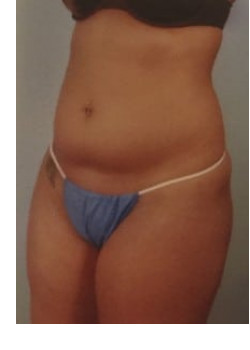 SmartLipo Before & After Image