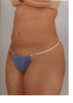 SmartLipo Before & After Image