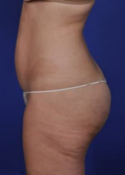 SmartLipo Before & After Image