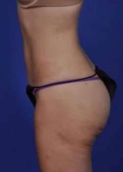 SmartLipo Before & After Image