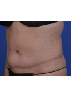 Tummy Tuck Before & After Image