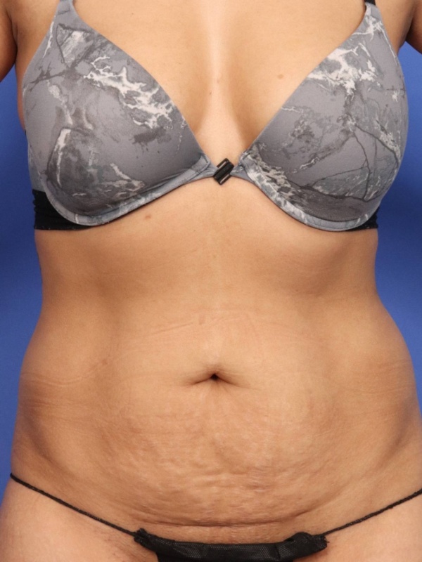 Tummy Tuck Before & After Image