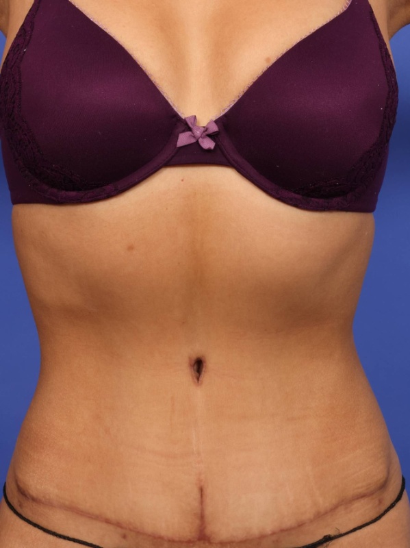 Tummy Tuck Before & After Image