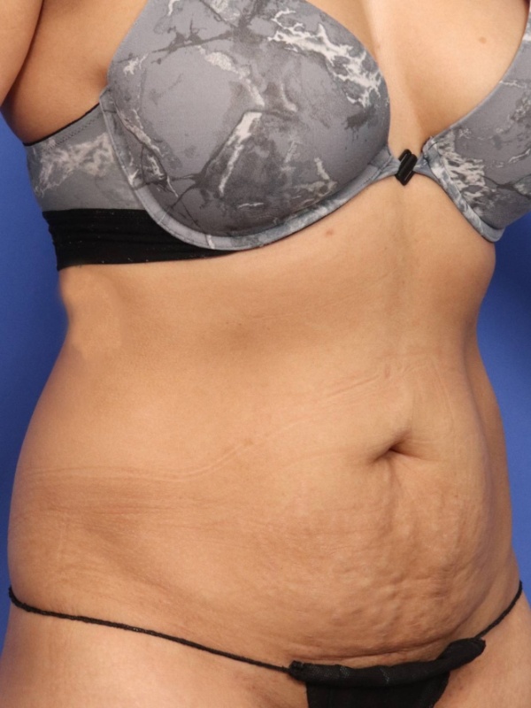 Tummy Tuck Before & After Image