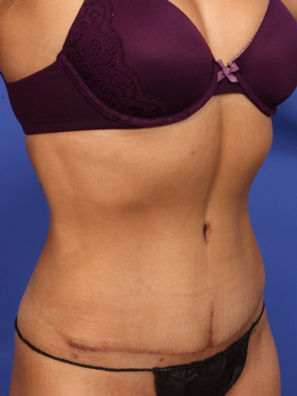 Tummy Tuck Before & After Image