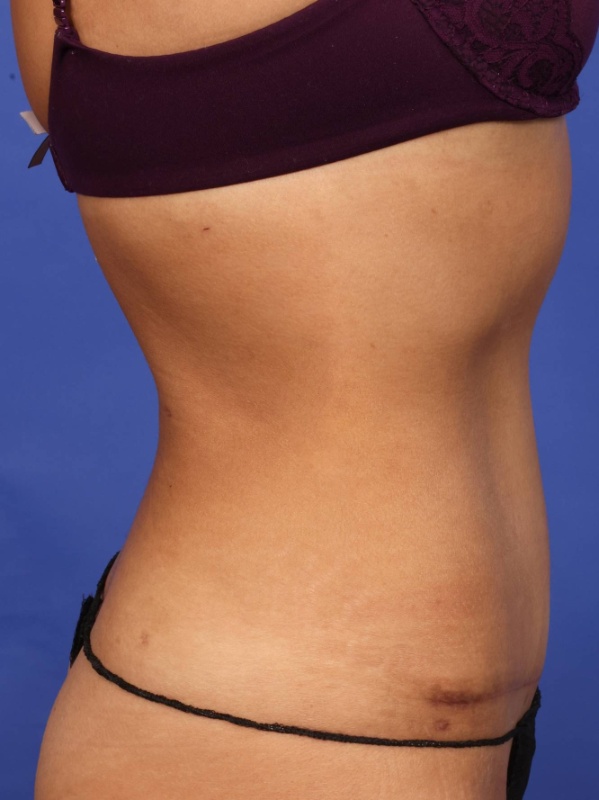 Tummy Tuck Before & After Image