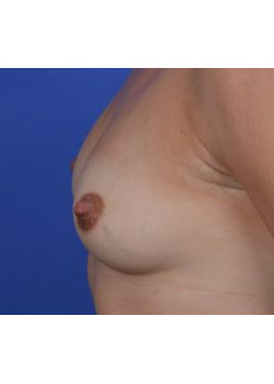 Breast Augmentation Before & After Image