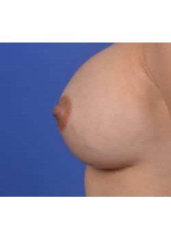 Breast Augmentation Before & After Image