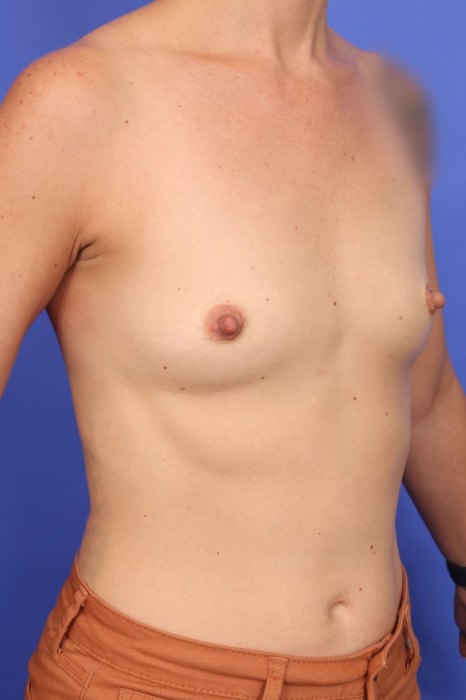 Breast Augmentation Before & After Image