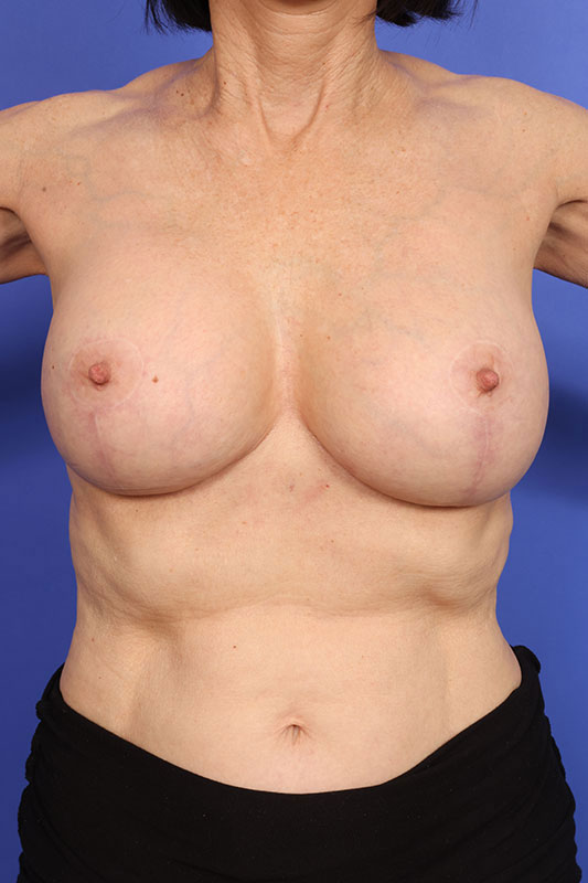 Breast Lift Before & After Image