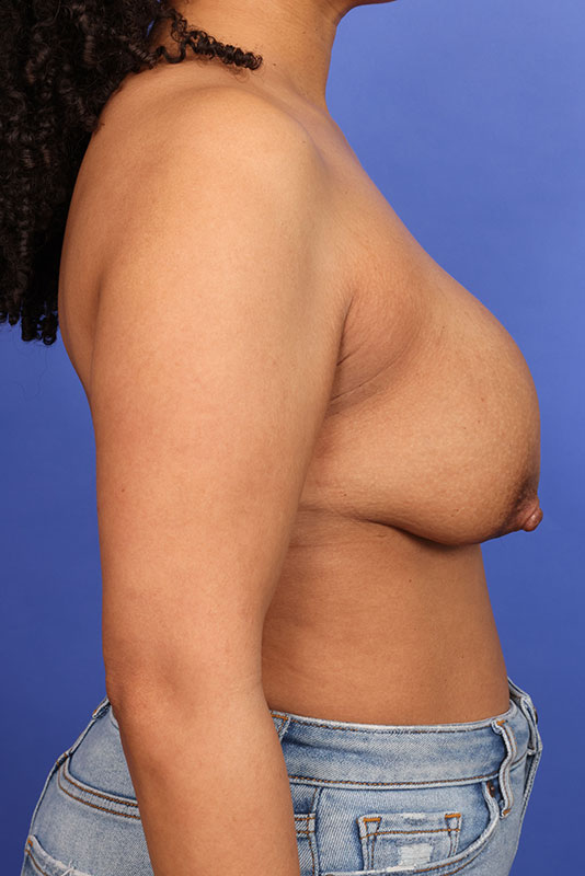 Breast Lift Before & After Image