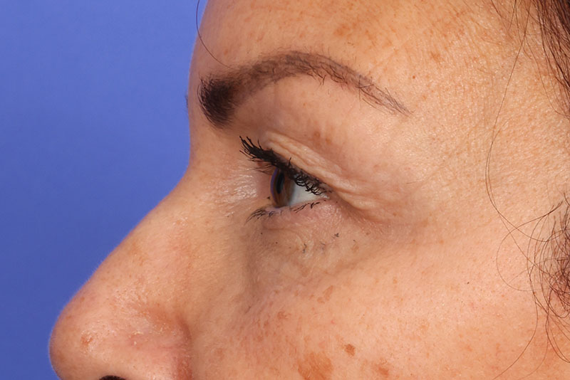 Blepharoplasty Before & After Image