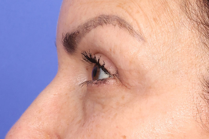 Blepharoplasty Before & After Image