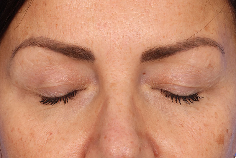 Blepharoplasty Before & After Image