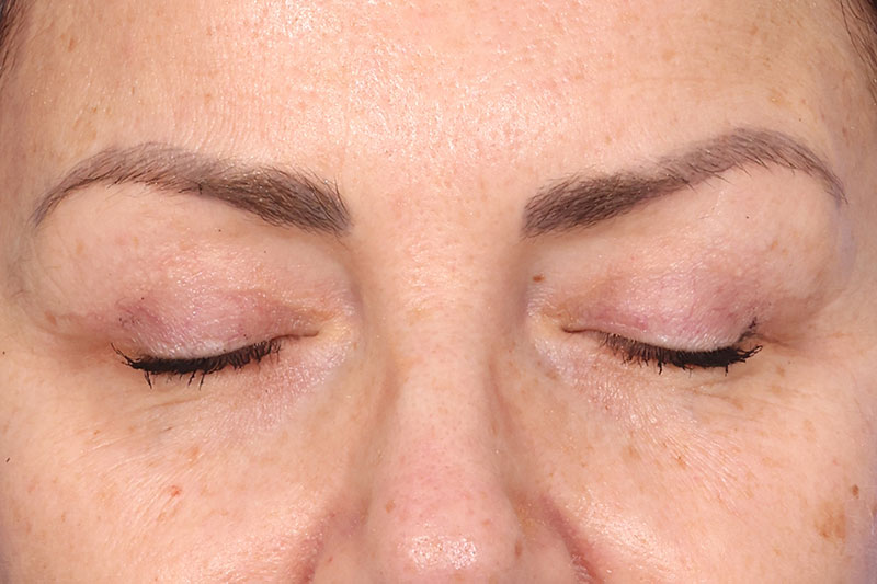 Blepharoplasty Before & After Image