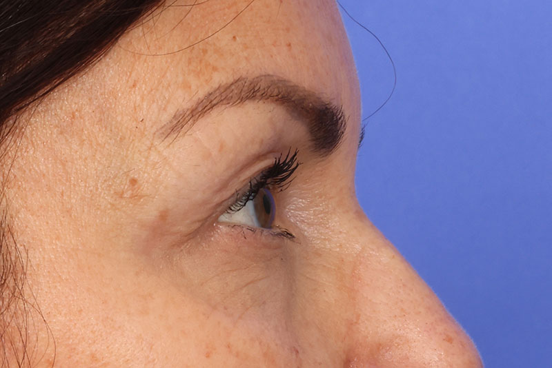 Blepharoplasty Before & After Image