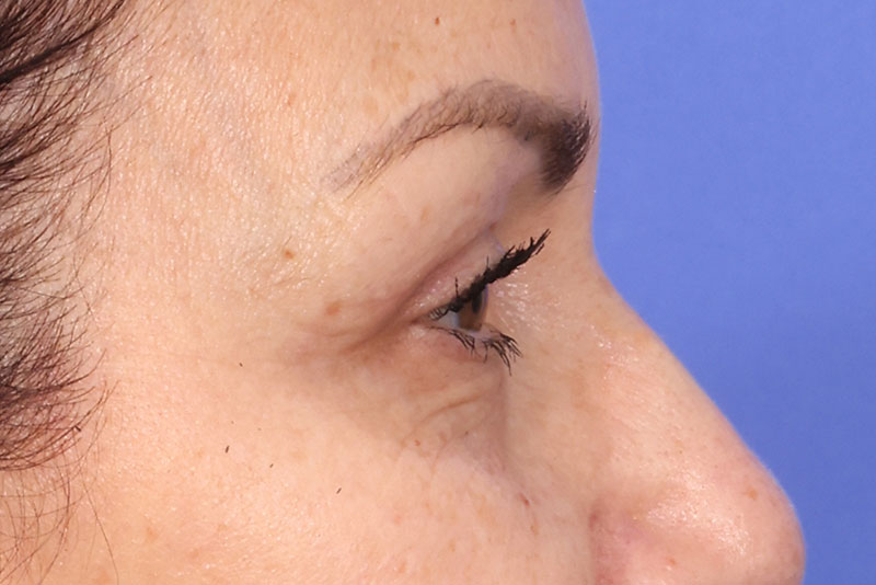 Blepharoplasty Before & After Image