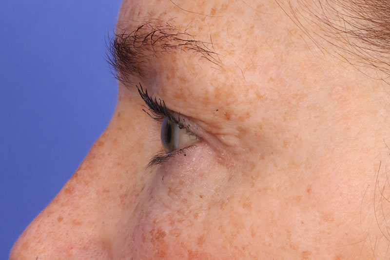 Blepharoplasty Before & After Image