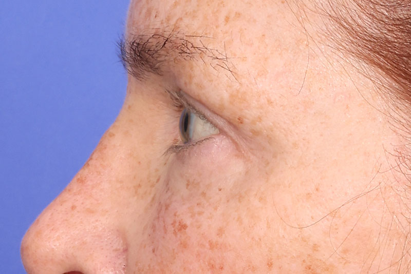 Blepharoplasty Before & After Image