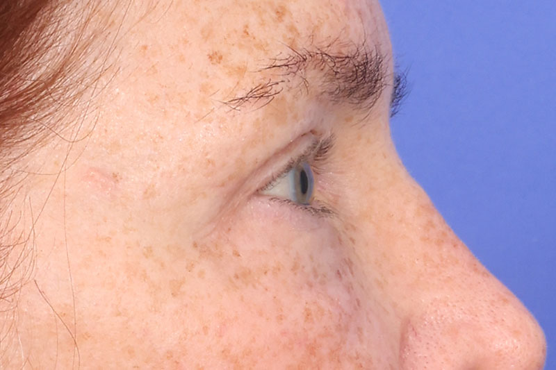 Blepharoplasty Before & After Image