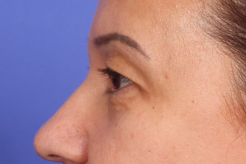 Blepharoplasty Before & After Image