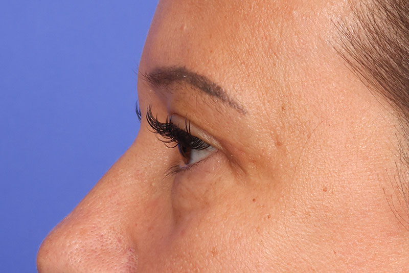 Blepharoplasty Before & After Image