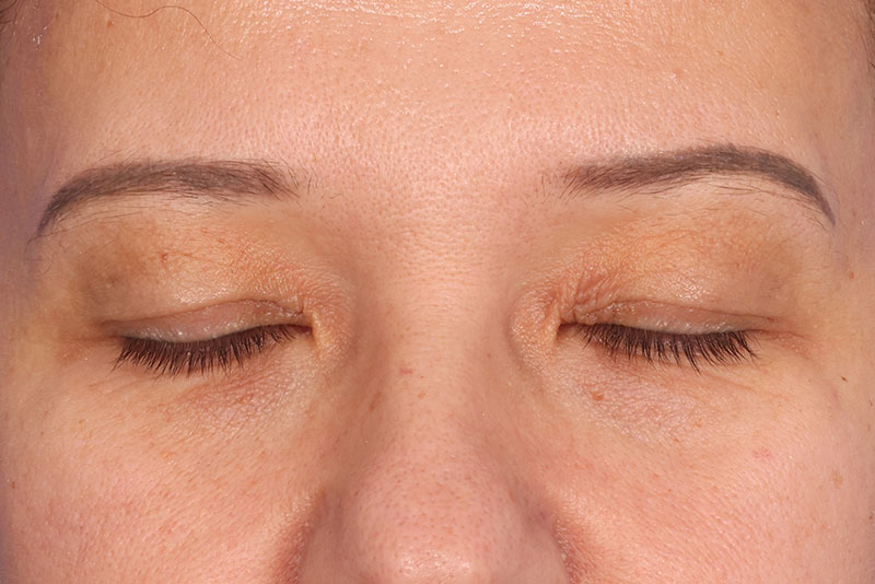 Blepharoplasty Before & After Image