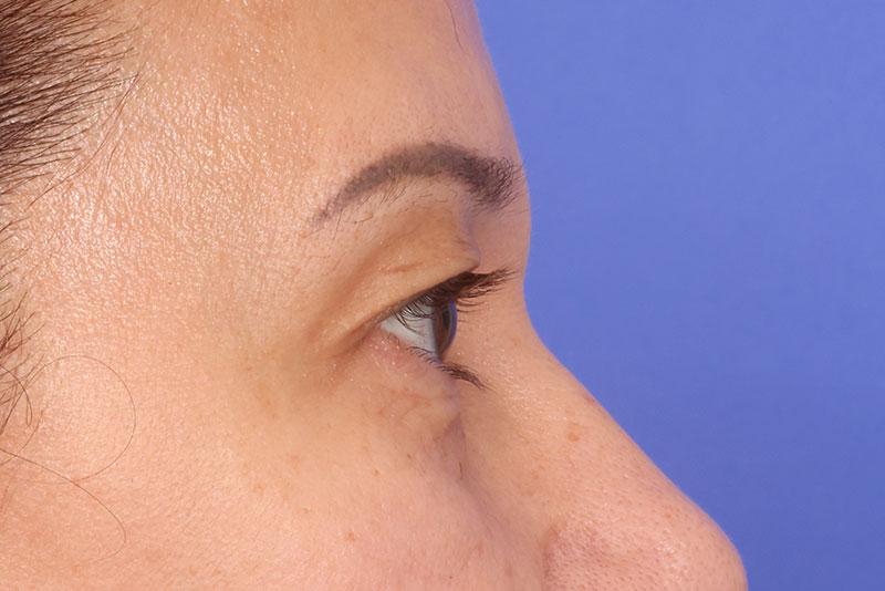 Blepharoplasty Before & After Image