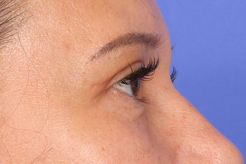 Blepharoplasty Before & After Image