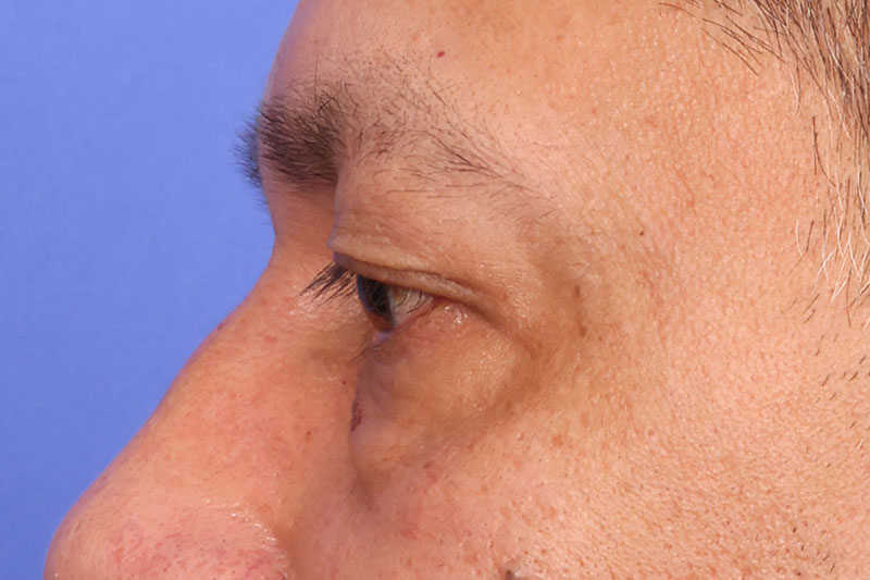 Blepharoplasty Before & After Image