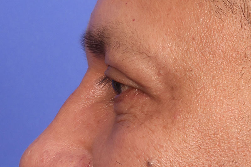 Blepharoplasty Before & After Image