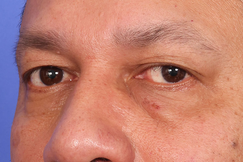 Blepharoplasty Before & After Image