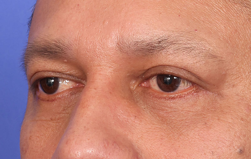 Blepharoplasty Before & After Image