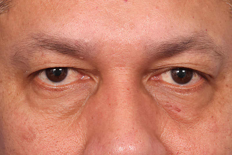 Blepharoplasty Before & After Image