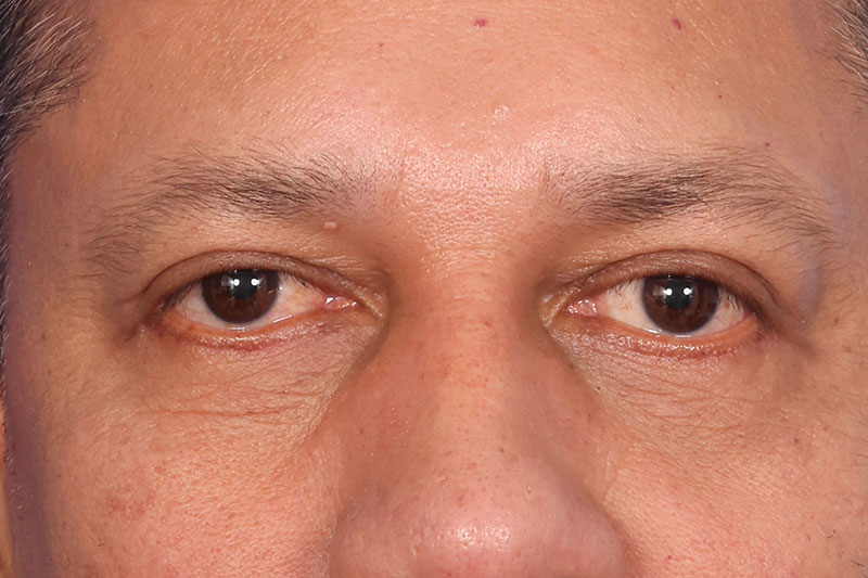 Blepharoplasty Before & After Image