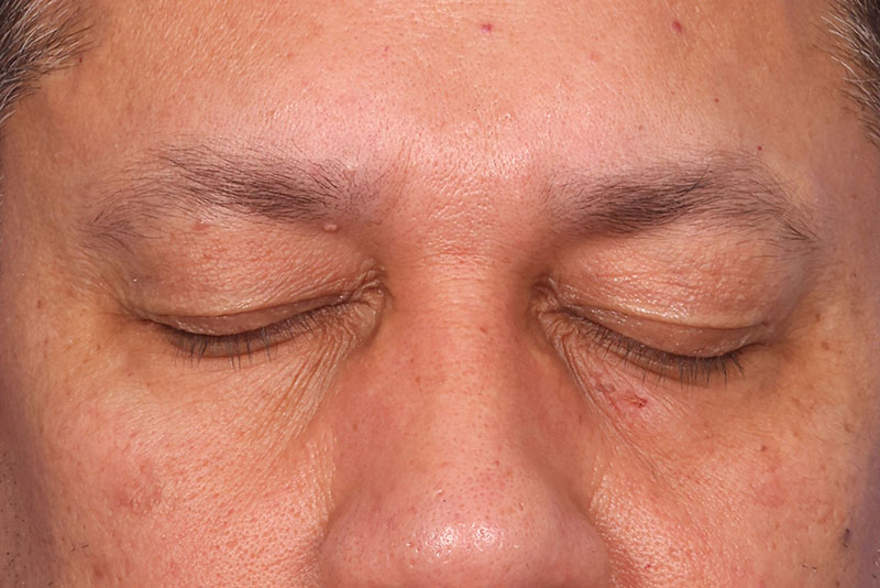 Blepharoplasty Before & After Image