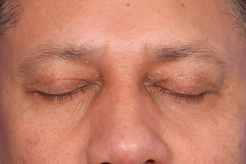 Blepharoplasty Before & After Image