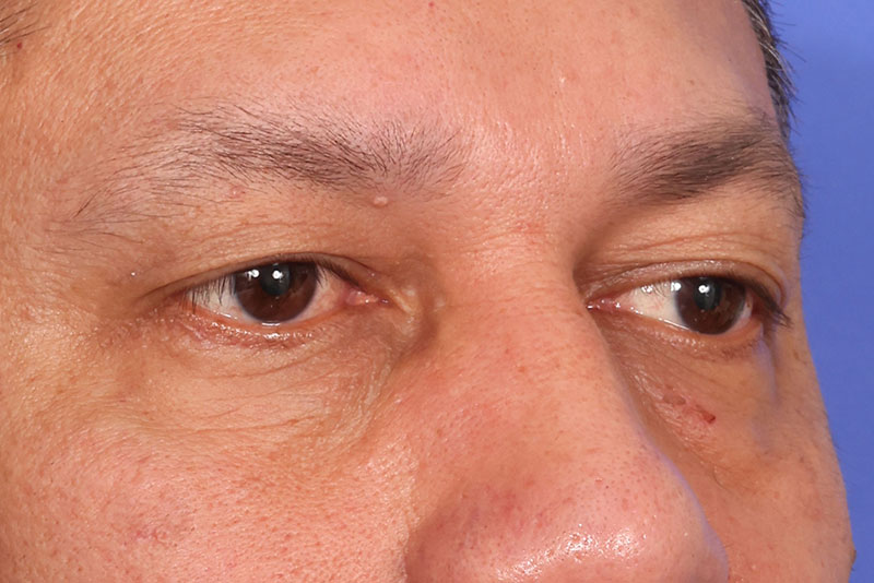 Blepharoplasty Before & After Image