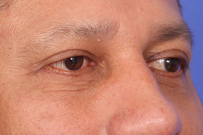 Blepharoplasty Before & After Image