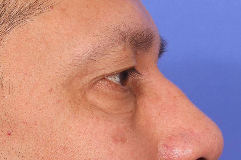 Blepharoplasty Before & After Image