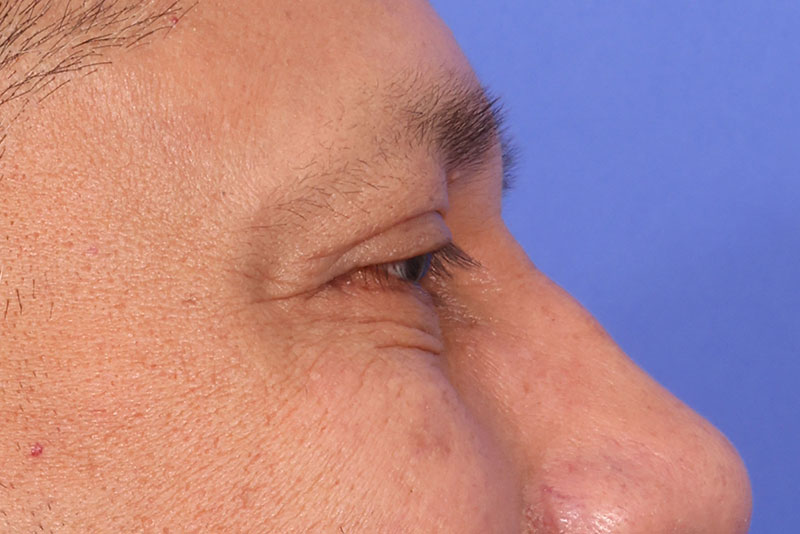 Blepharoplasty Before & After Image