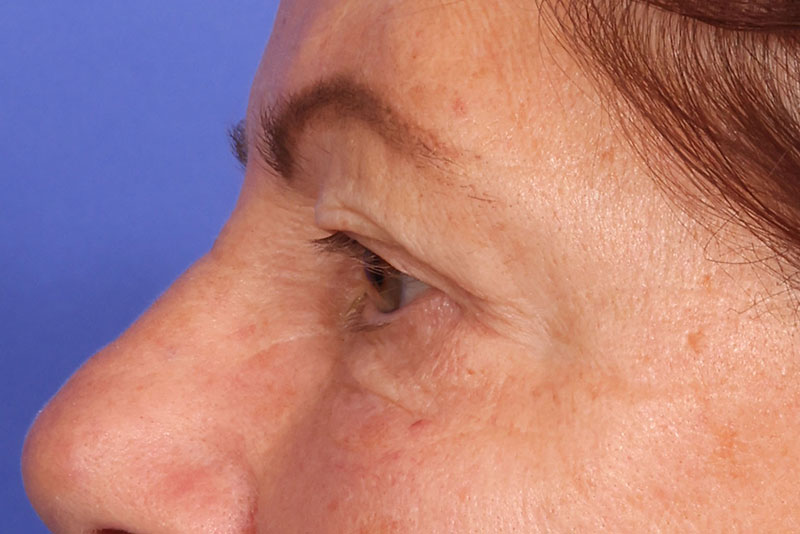 Blepharoplasty Before & After Image