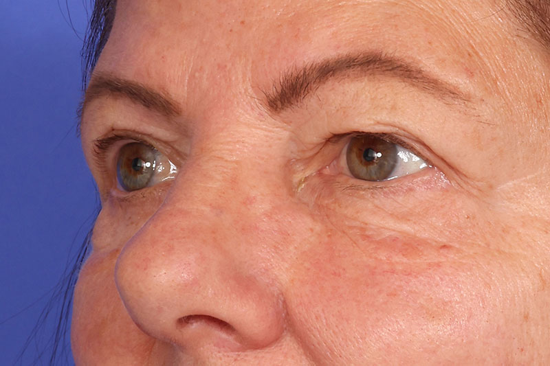 Blepharoplasty Before & After Image