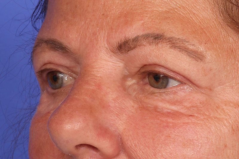 Blepharoplasty Before & After Image