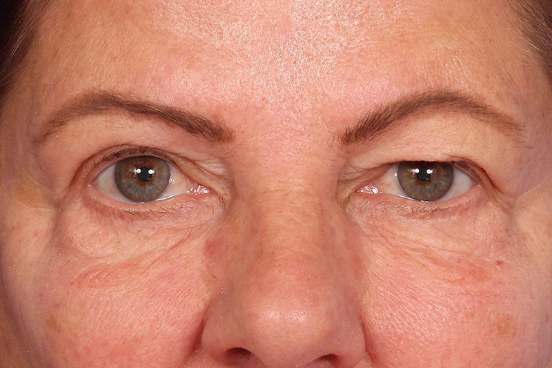 Blepharoplasty Before & After Image