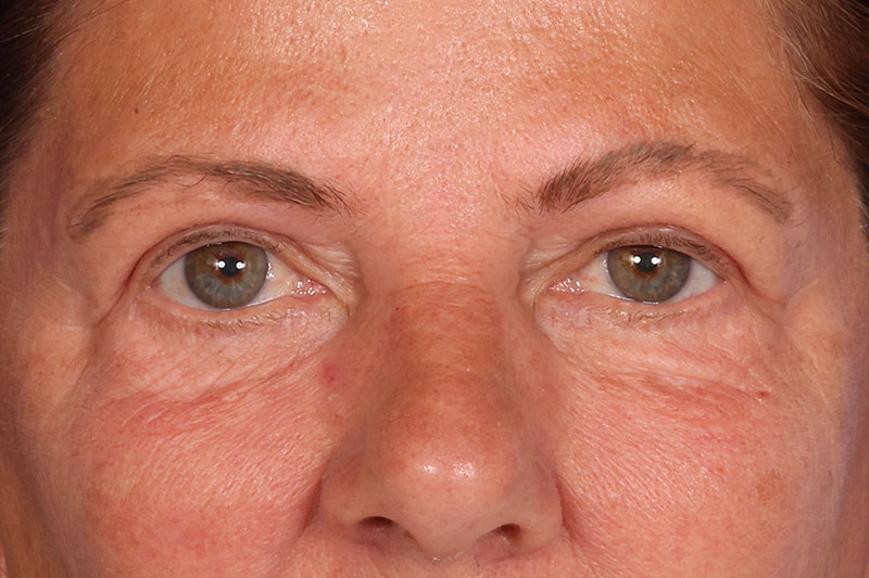 Blepharoplasty Before & After Image