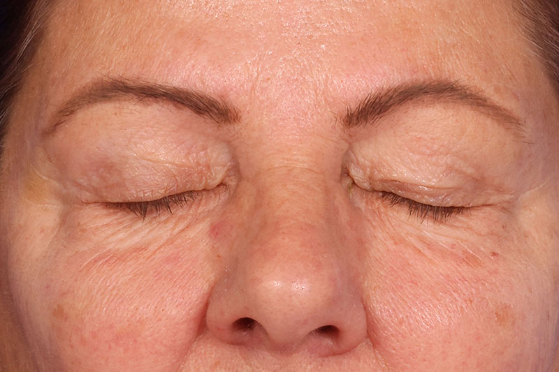 Blepharoplasty Before & After Image