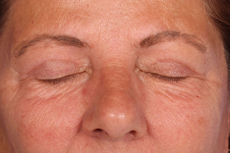 Blepharoplasty Before & After Image