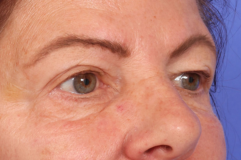 Blepharoplasty Before & After Image